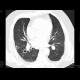 Lung metastases, cavitating: CT - Computed tomography